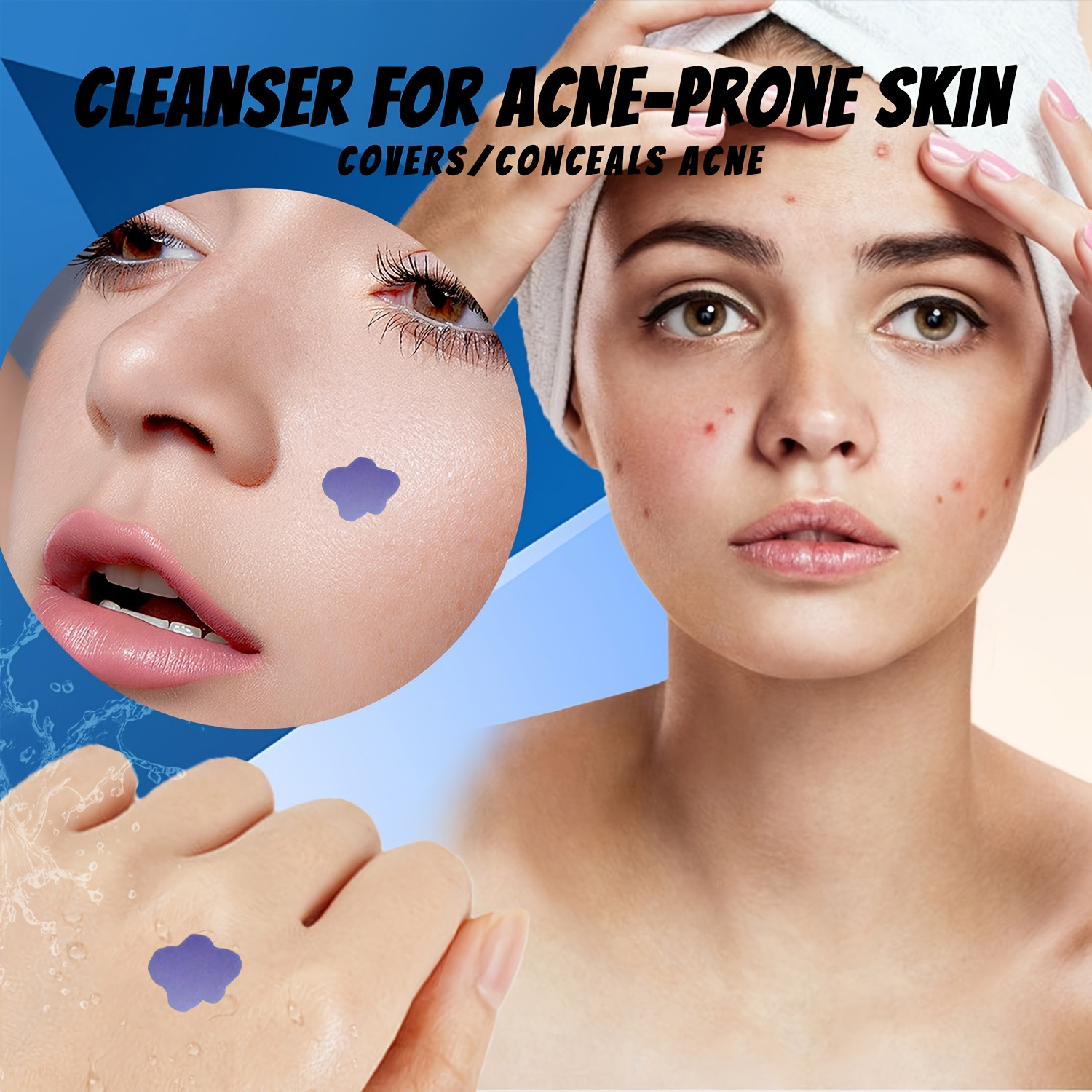 Microneedle Acne Pimple Patch  - Skincare Acne review and price